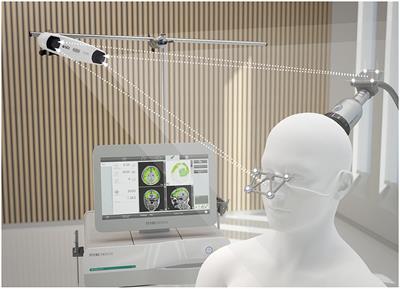 Retrospective real-world pilot data on transcranial pulse stimulation in mild to severe Alzheimer's patients